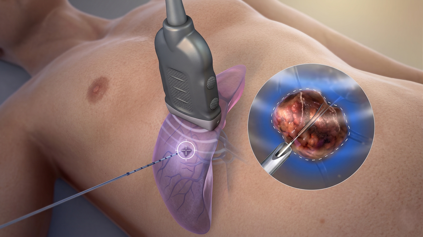 Radiofrequency Ablation Treatment
